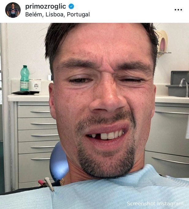 📸 Oof... Roglic's streak of bad luck isn't over yet: Slovenian loses a tooth just before the Vuelta