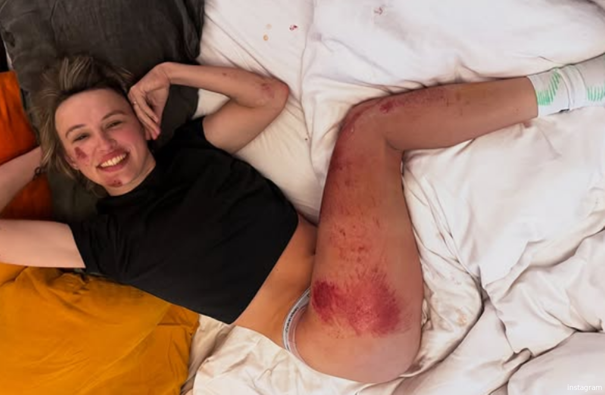 📸 Niewiadoma toont schade na Strade Bianche-val en reageert uitgebreid: 'Alsof er iets weggenomen is'
