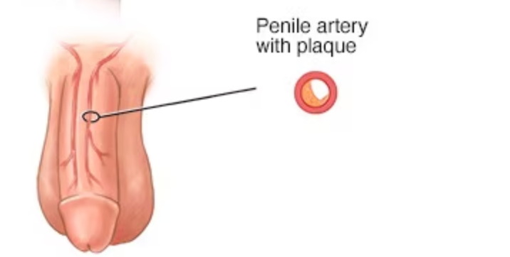 Erectile Dysfunction: An Early Warning Sign for Heart Disease