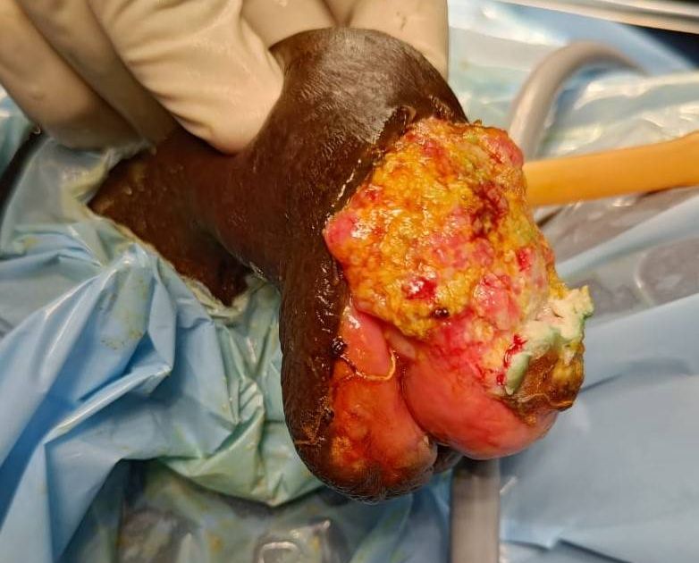 Removing 30% of My Penis Saved My Life, But the Images Were Gruesome