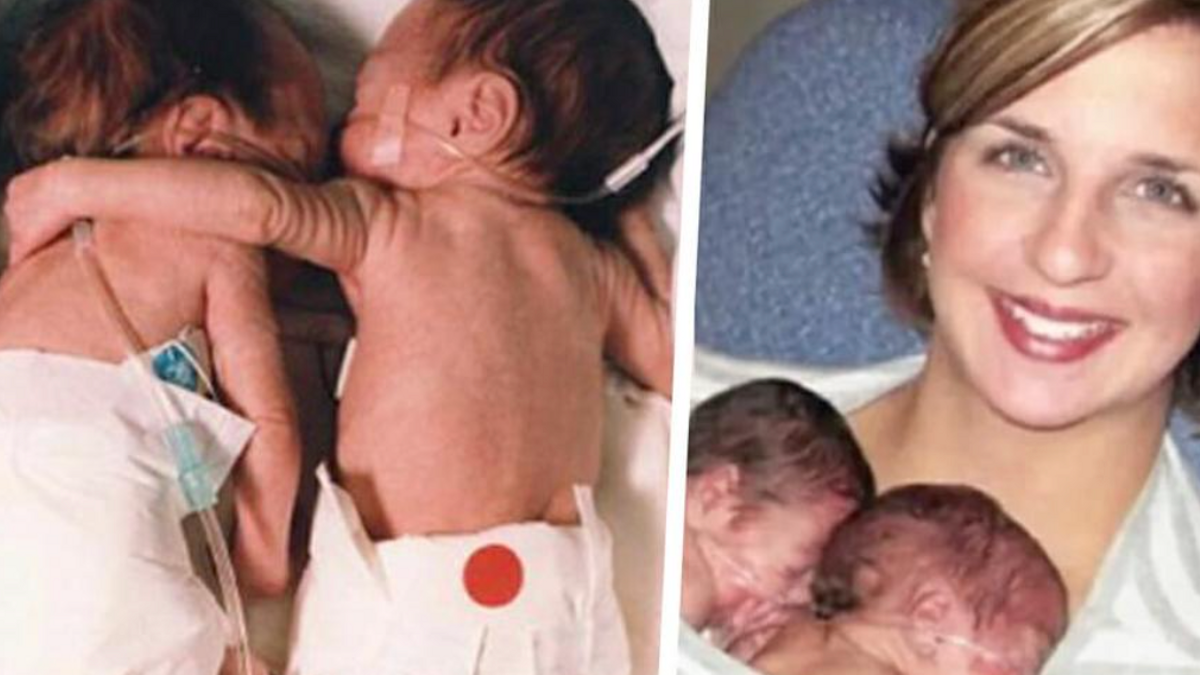 Te vroeg geboren baby wordt blauw en staat op het punt te sterven als haar tweelingzus haar een knuffel geeft en haar leven redt