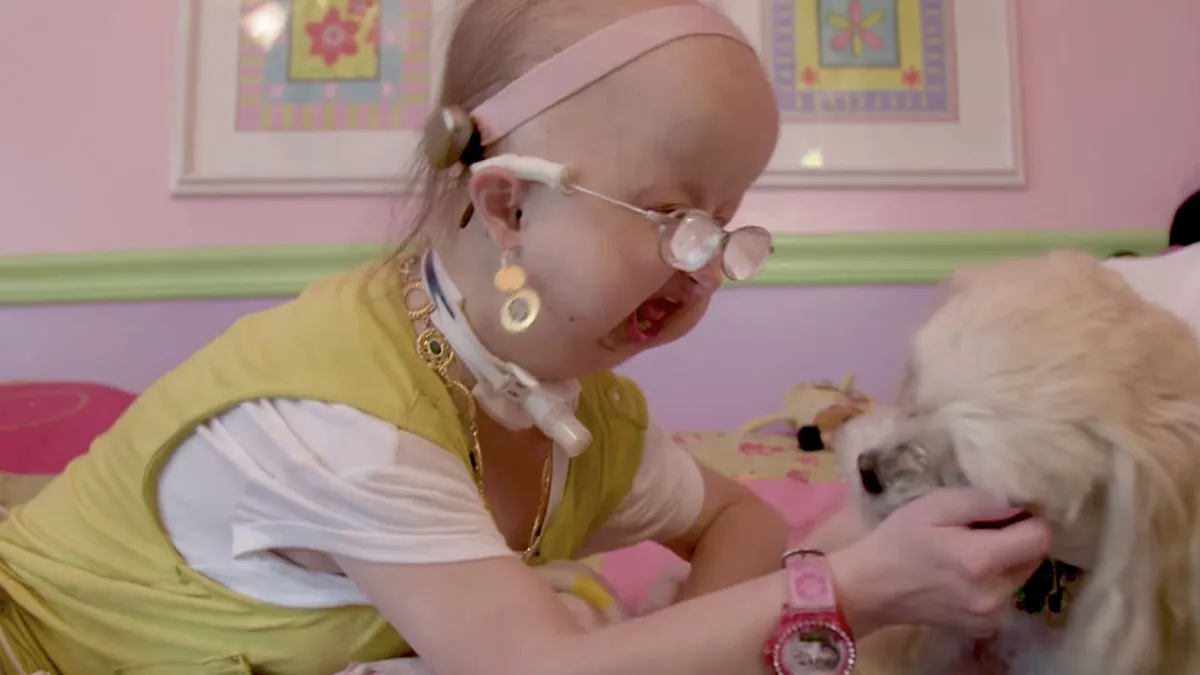 Michelle heeft Hallermann–Streiff syndrome en dat zuigt hard