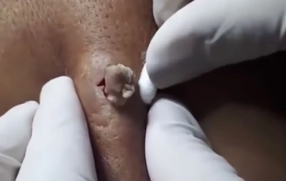 10 jaar oude pukkel poppen