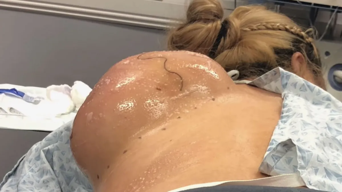 Dr. Pimple Popper gaat serieus om met een gigantische lipoom