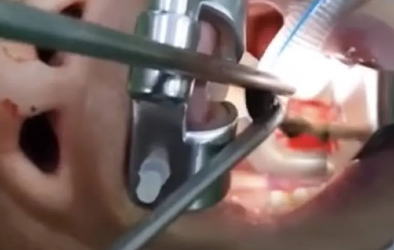 Laat anders even een levende bloedzuiger uit je holte vissen