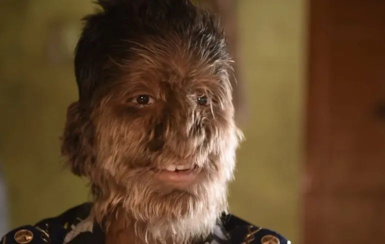 13-jarige knaap heeft het zogenaamde weerwolf syndroom