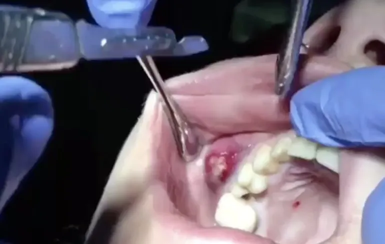 Abces in mond laten poppen