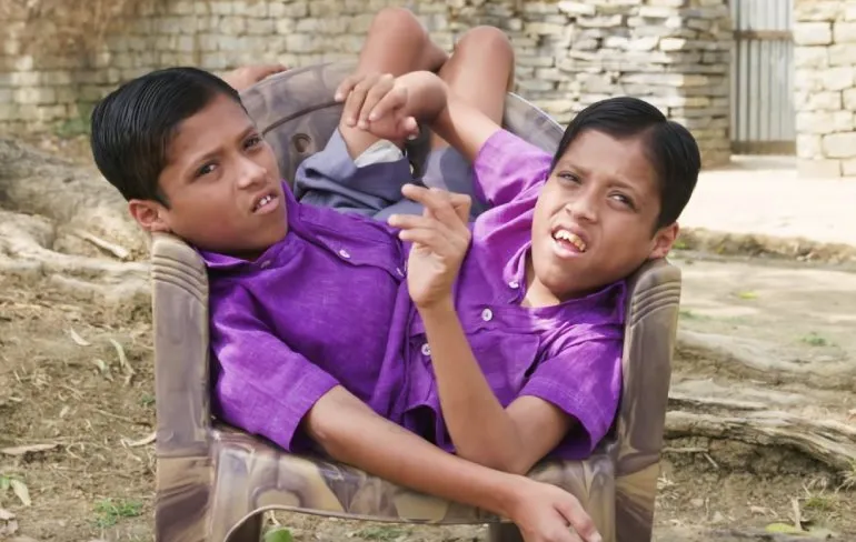 Siamese tweeling  Shivanath en Shivram willen helemaal niet gescheiden worden