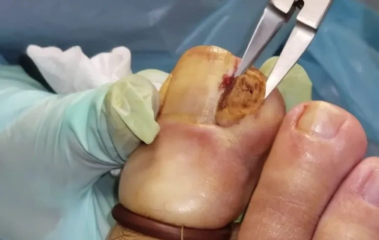 Lekker even een ingegroeide teennagel verwijderen