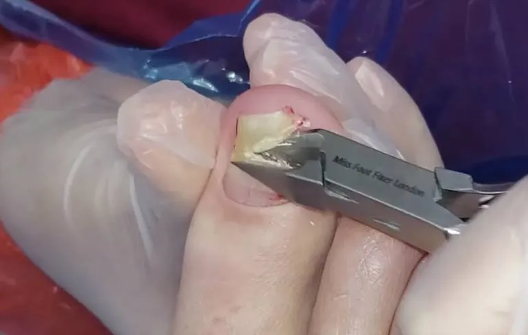 Miss Foot Fixer verwijderd nagel