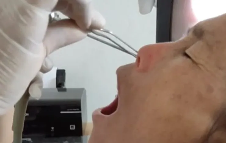 Bloedzuiger uit de neus van een dame vissen