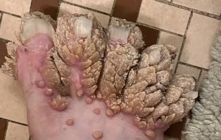 Sebastian heeft epidermodysplasia verruciformis, iets waar je goed zonder kan