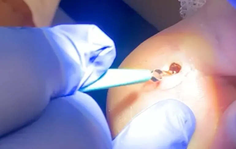 De splinter van Jake die er prachtig uit kwam