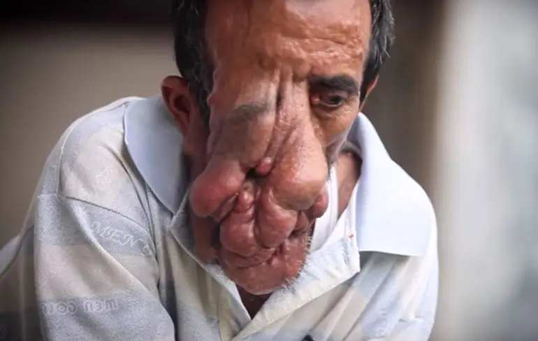 Ashok Shrestha heeft last van neurofibromatose