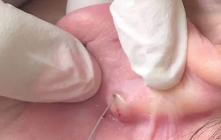 Dr. Pimple Popper doet een mee-eter achter het oor verslaan