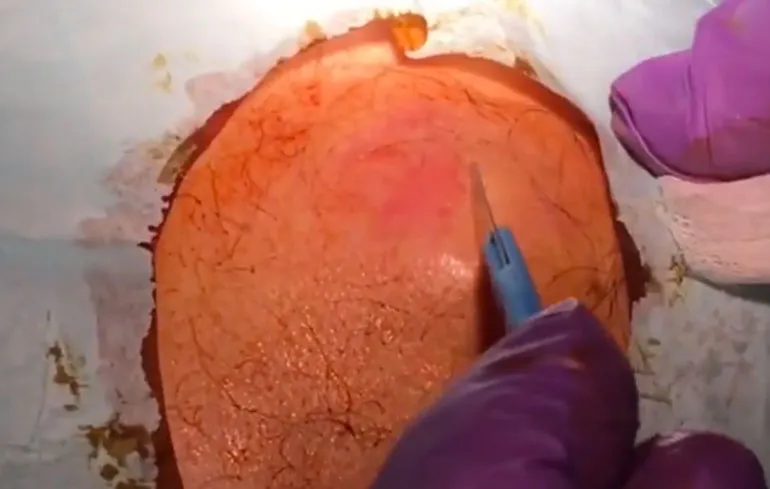 Man laat mega cyste uitknijpen