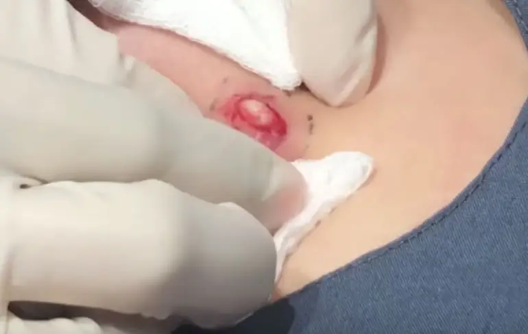 Dr. Pimple Popper heeft weer een lekkere cyste