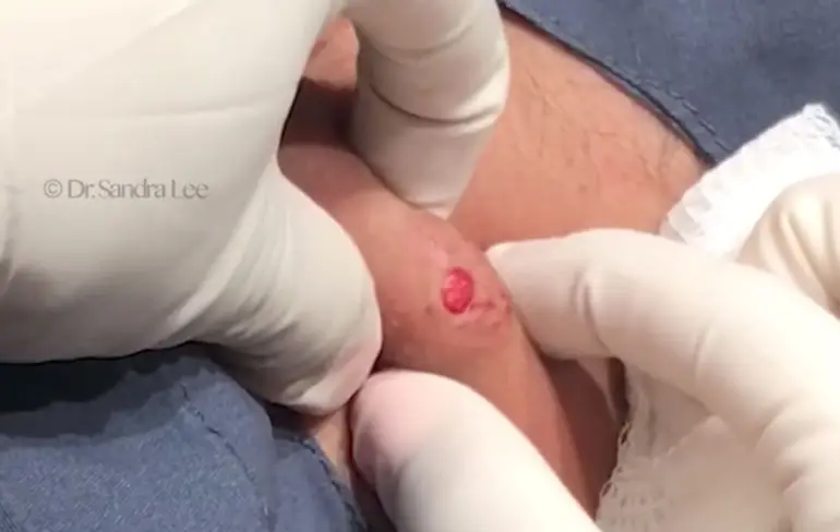 Dr. Pimple Popper knijpt de mayo uit cyste