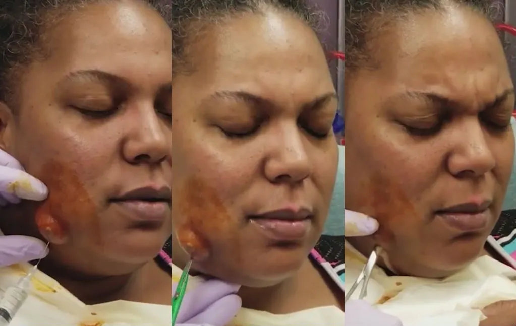 Nicole liet even haar abces poppen