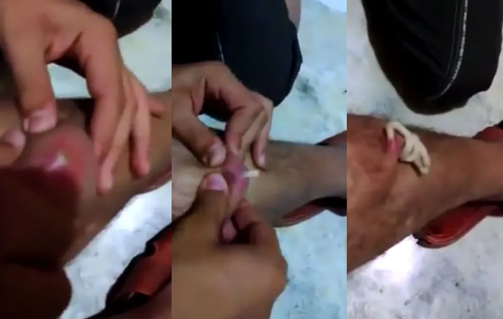 De mega pukkel die maar blijft geven