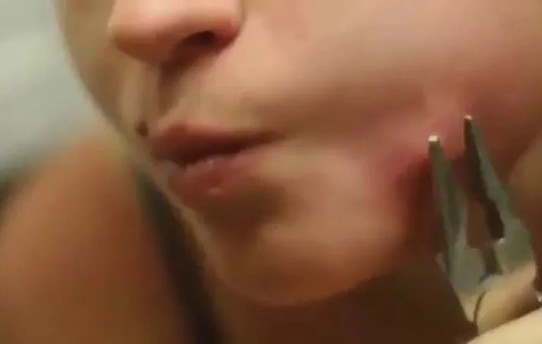 Even de kern van een pukkel uit je wang trekken