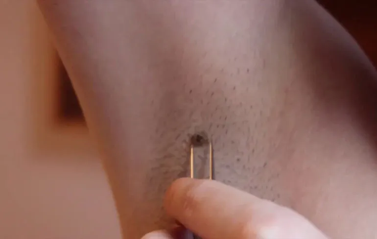 Zo, heeft er even eentje een ingegroeide haar