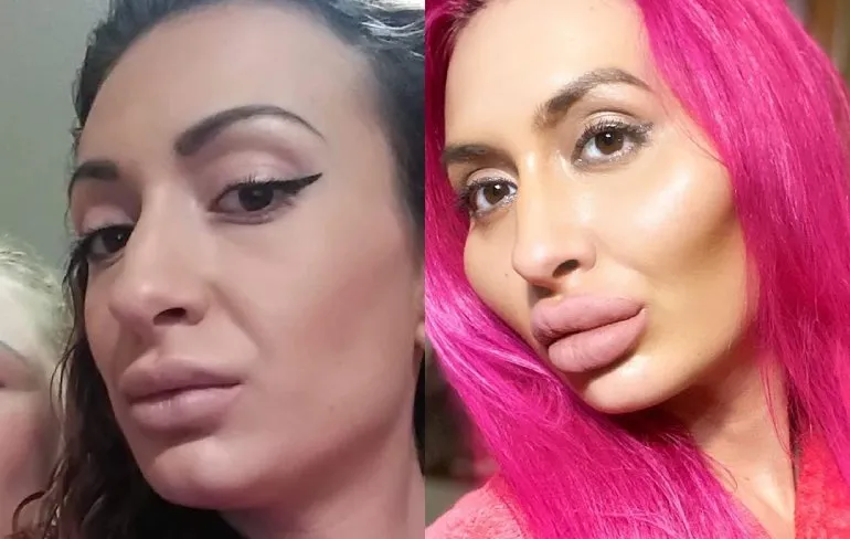 22-jarige Bulgaarse claimt dikste lippen ter wereld te hebben