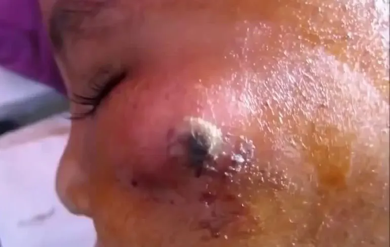 Even het abces op je wangen laten poppen