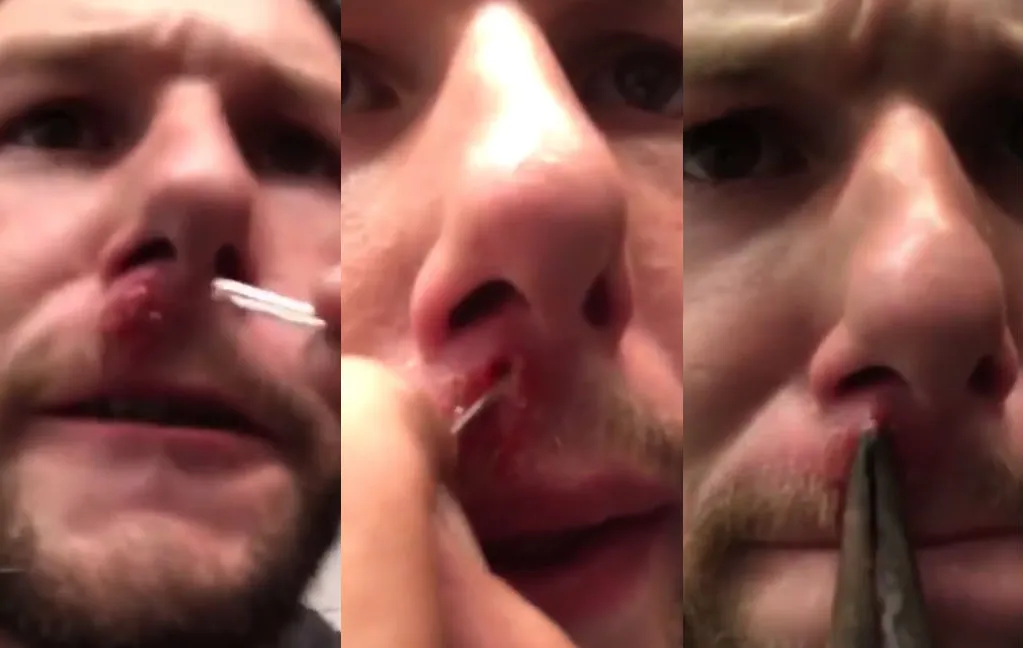 Gast voelt wat boven zijn lip groeien en lost het op met punttang