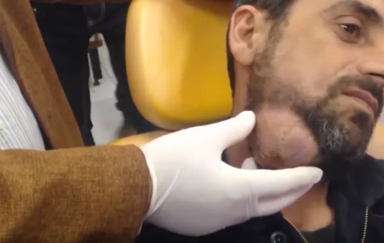 Abces prikken met dokter Osama Makkia