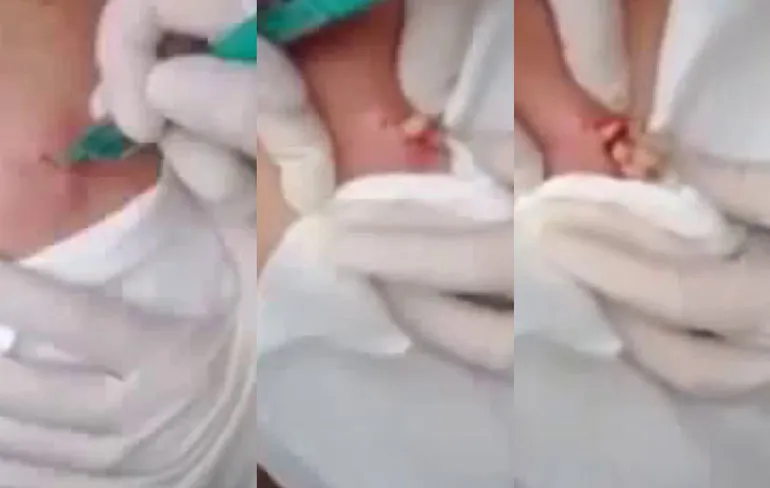 Lekker snijden en knijpen in pus rug