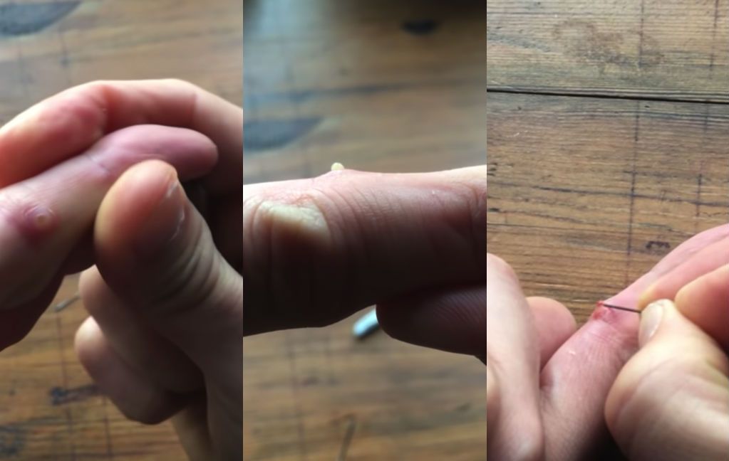Na 2 maanden splinter uit vinger halen