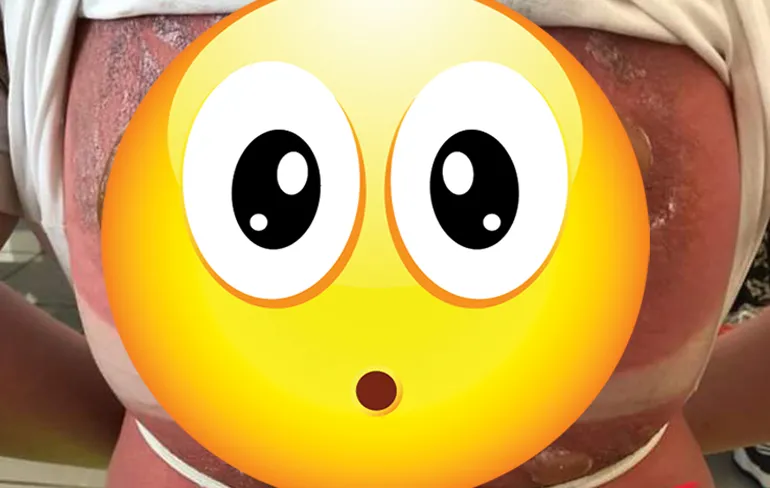 16-jarig meisje vergat zonnebrand te smeren tijdens vakantie op Cuba