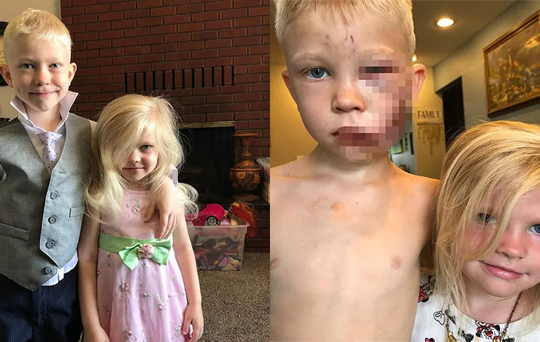 6-jarige Bridger flink toegetakeld nadat hij zijn zusje heeft gered van hondenaanval