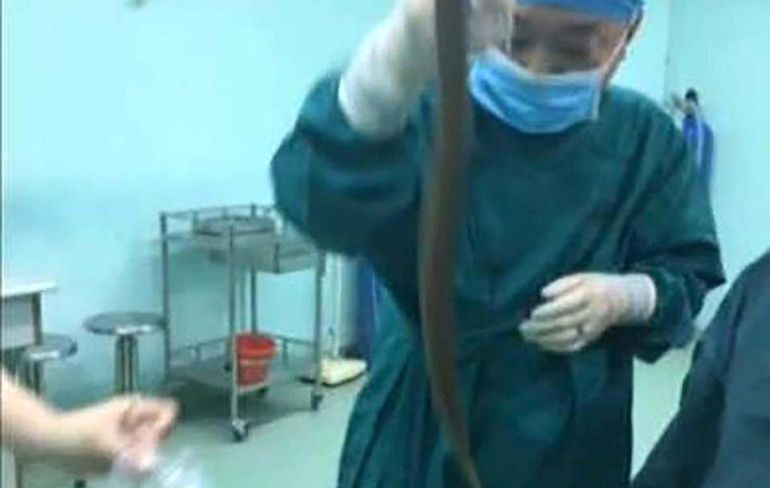 Chinese artsen verwijderen levende aal uit zelfdokterende man