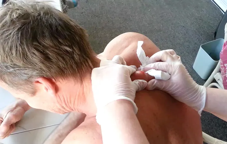 Dag puist van 30 jaar: Zo'n grote pusbal jonge! BAM!