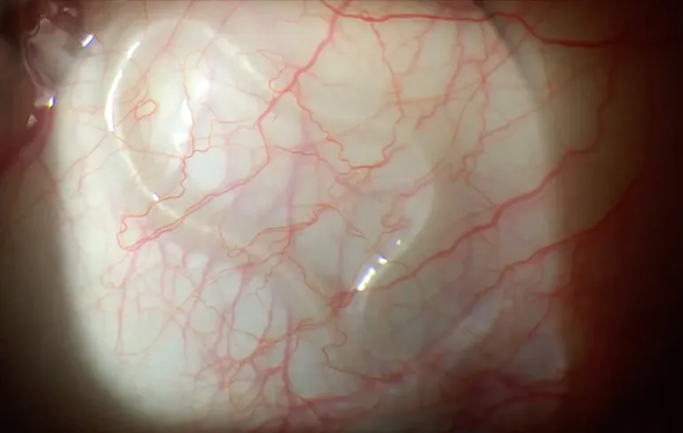 Dokter, er zit een worm in mijn oog!