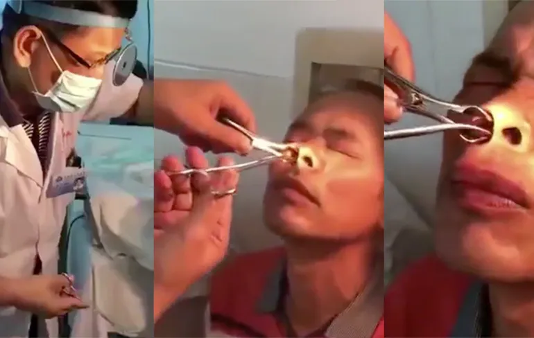 Dokter, ik heb al 10 dagen een bloedneus, kunt u eens kijken?