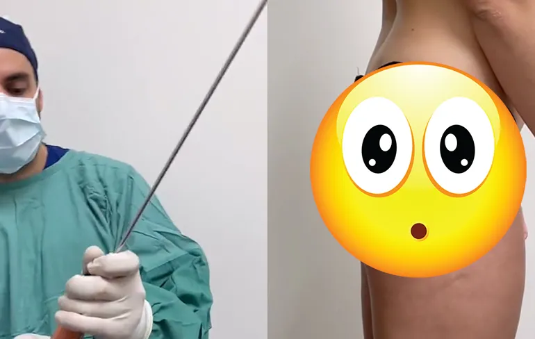 Dr. Daniel Aronov laat op Tik Tok zien hoe hij een Kim Kardashian achterwerk maakt