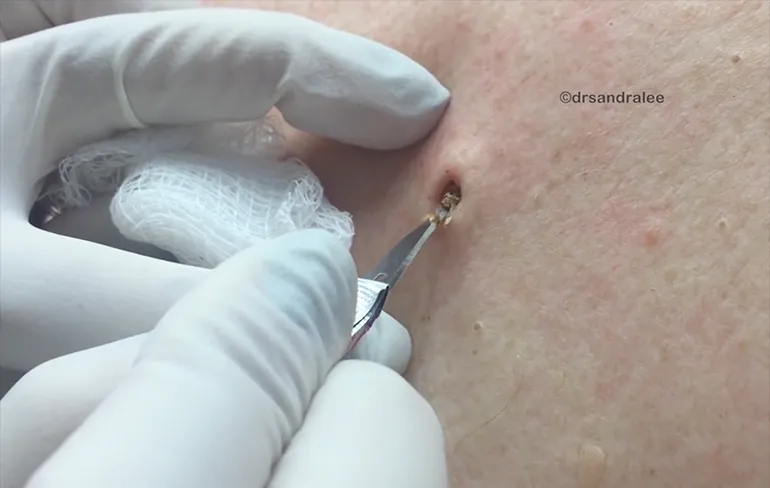 Dr. Pimple Popper heeft mee-eters Compilatie video gemaakt