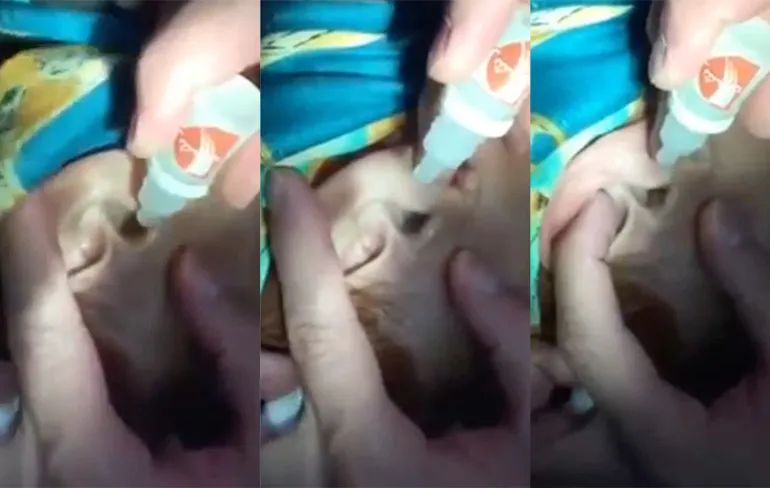 Duizendpoot verwijderen uit oor van meisje...