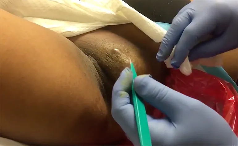 Eet smakelijk: Vrouw wordt van abces onder oksel af geholpen...