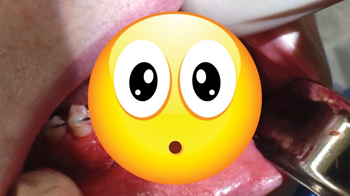 Elektrische sigaret ontploft in mond, verbrijzelt kaak en tanden scheef