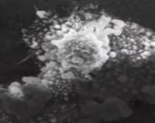 Emma geneest van kanker door HIV