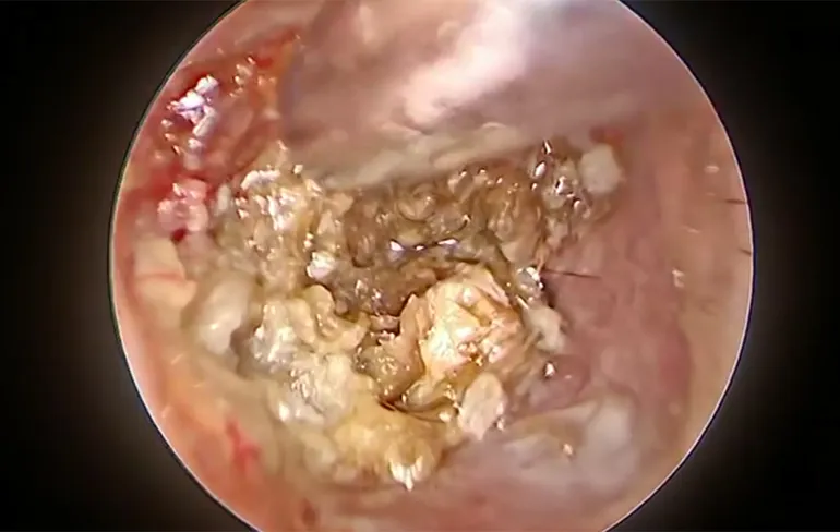 En zo ziet het eruit als je hele gehoorkanaal vol met oorsmeer zit!