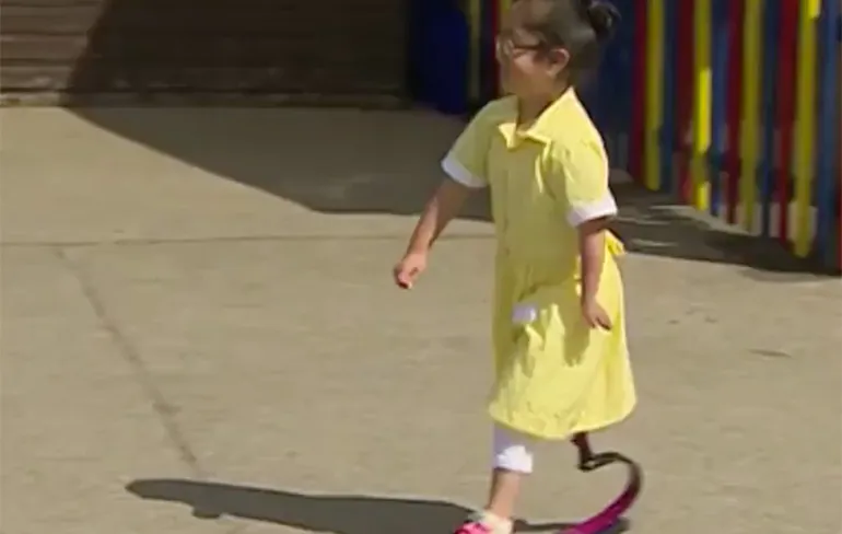 Feel Good: Het moment dat meisje haar nieuwe prothese aan vrienden laat zien