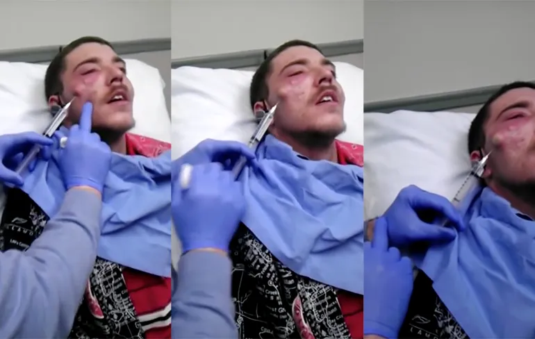 Gast laat cyste zo groot als tennisbal van gezicht verwijderen