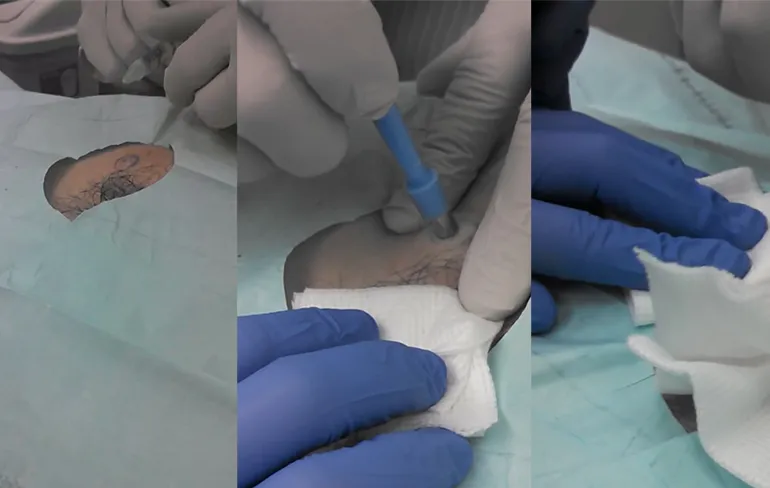 Grote cyste geplopt en moet met hechtingen dichtgemaakt worden!