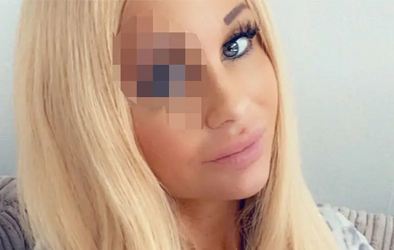 Het zit Samantha de Jong aka Barbie ook niet mee: Boel is ontstoken