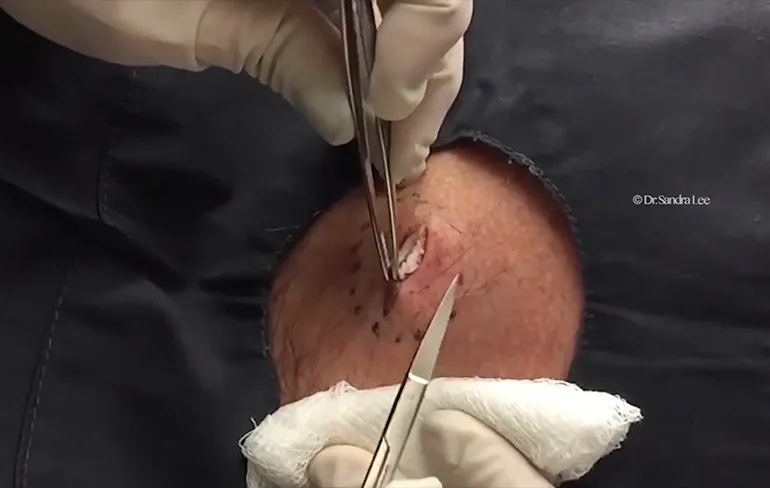 Iemand met Bermuda Driehoek in praktijk Dr. Pimple Popper